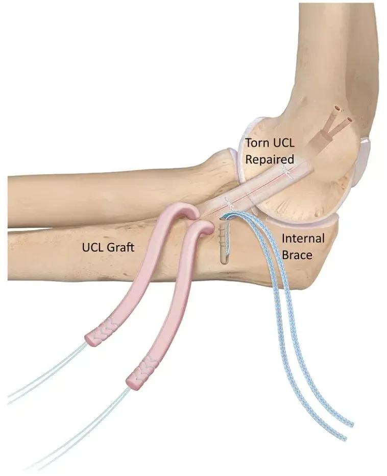 Cold Therapy Wraps and Elbow Injury Recovery: What to Know